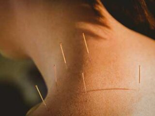 Acupuncture treatment